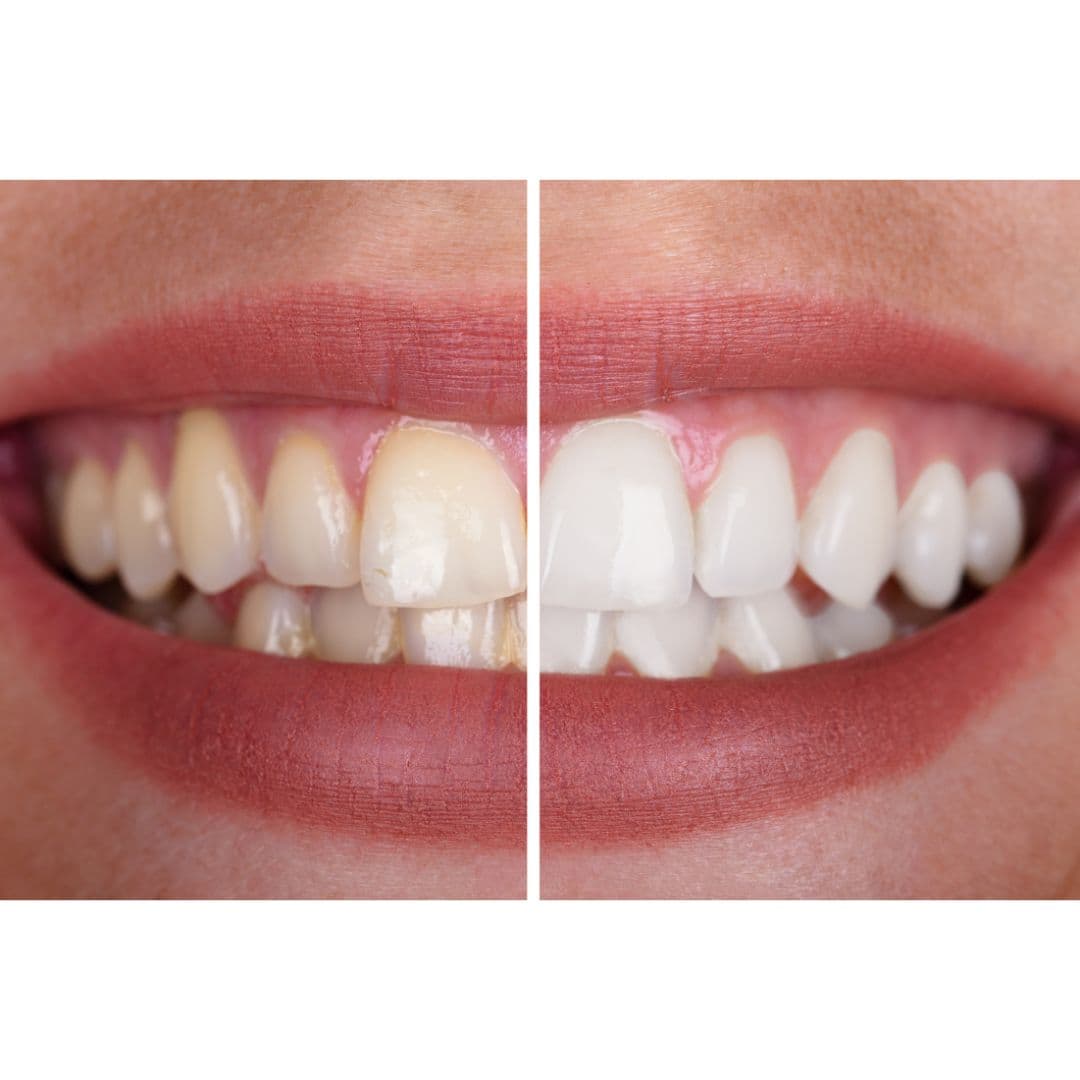 Teeth cleaning and whitening appointment