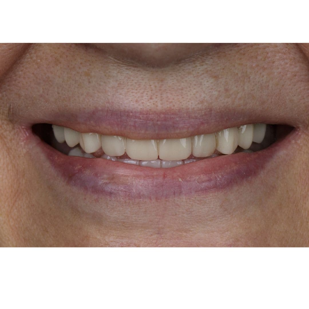 Full mouth rehabilitation treatment planning