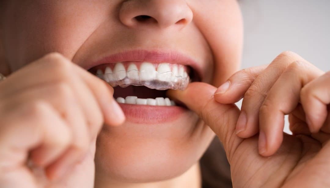 Clear aligner and braces consultation