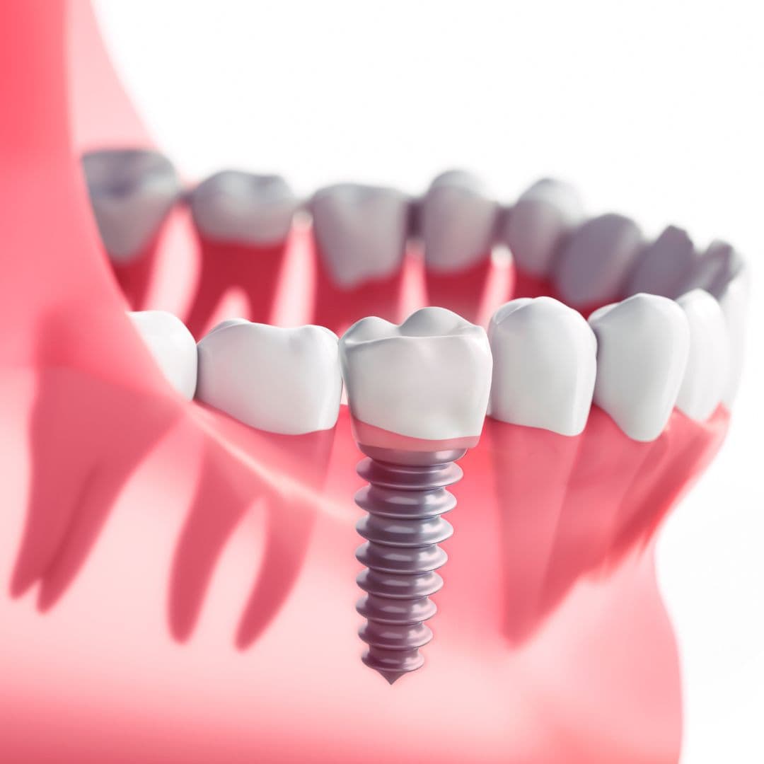 Dental implant consultation at Emerge Dental Studio