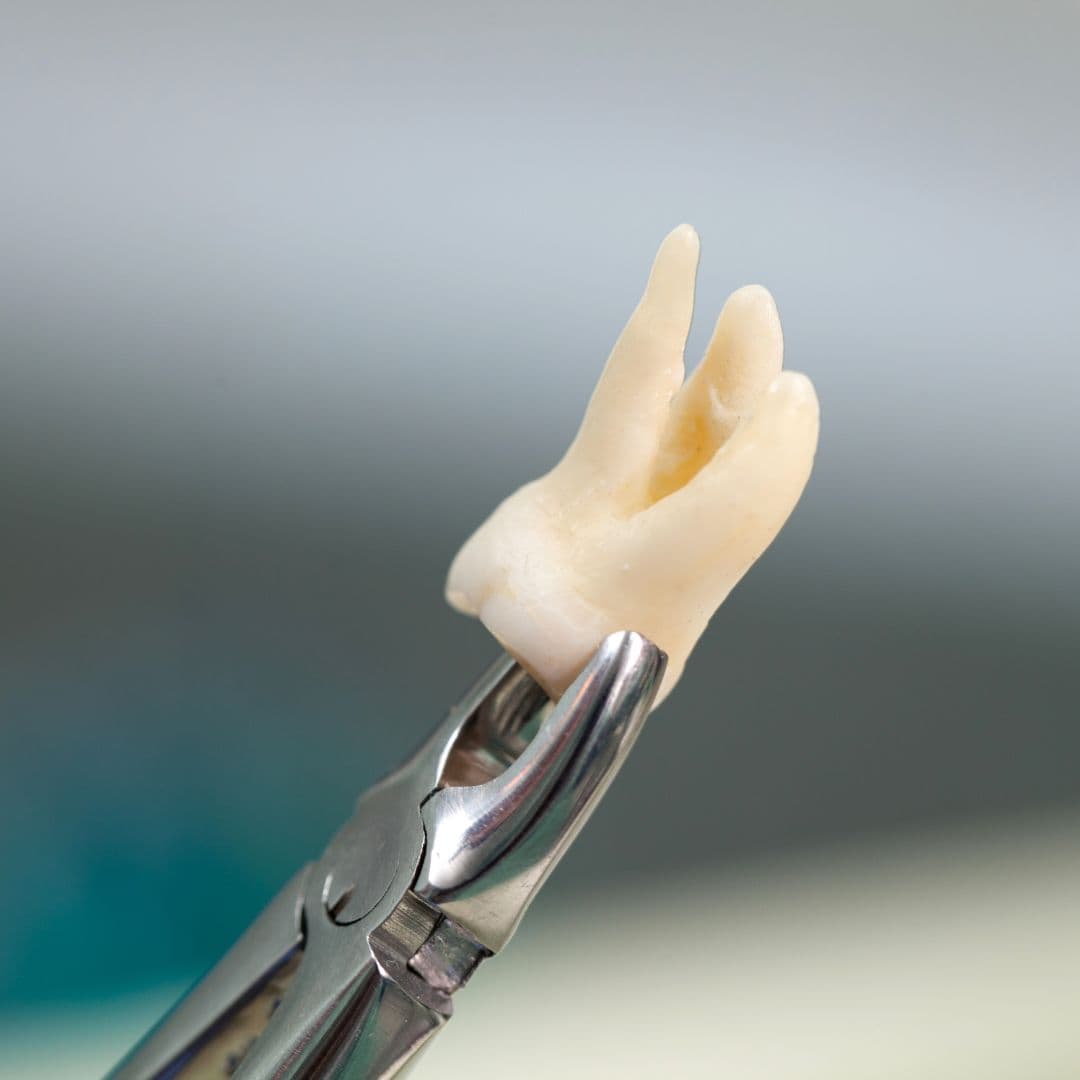Wisdom tooth extraction consultation